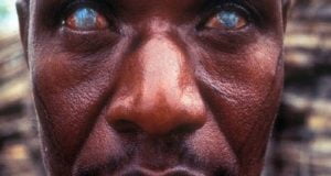 River Blindness: Expert Says 48m Nigerians At Risk Of Contracting Disease