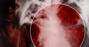 Tuberculosis: Programme Manager Says Disease Detection In Kaduna Increased 33% In 1 Year