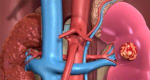 Kidney: Researchers Get N36m Grant To Probe Preponderance Of Diseases In Hadejia Valley