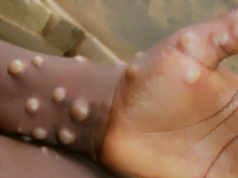 NCDC Reports 24 New Cases Of Monkeypox In One Week