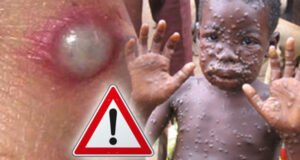 Monkey Pox: Borno Records Four Cases