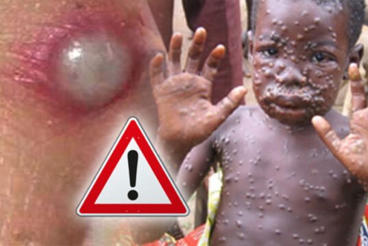 Monkey Pox: Borno Records Four Cases