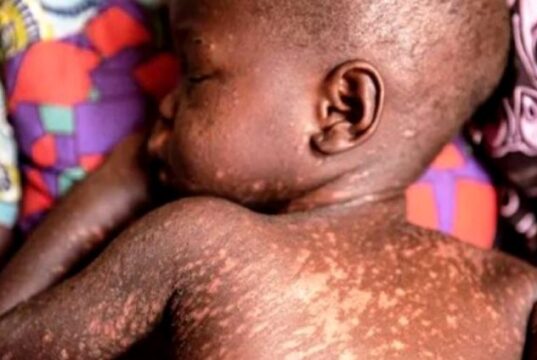 Measles Outbreak: Adamawa Order Closure Of Schools. 20240506 174948 scaled