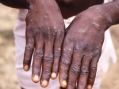MPOX: Nigeria, Others To Benefit As WHO Plans $135m Fund. Monkeypox scaled 1
